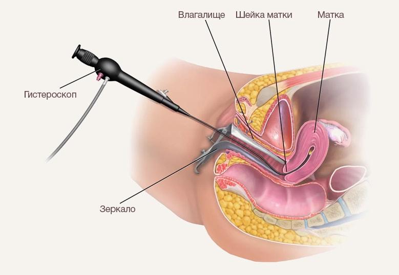 Гистероскопия Киев